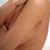 Breast Acne and How to Treat It