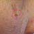 Coping With Excessive Skin Tags